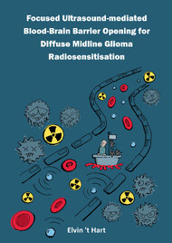 Focused Ultrasound-mediated Blood-Brain Barrier Opening for Diffuse Midline Glioma Radiosensitisation