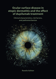 Ocular surface disease in atopic dermatitis and the effect of dupilumab treatment