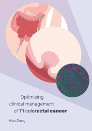 Optimizing clinical management of T1 colorectal cancer