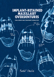 Implant-retained maxillary overdentures