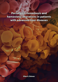 Portal vein thrombosis and hemostatic alterations in patients with advanced liver diseases